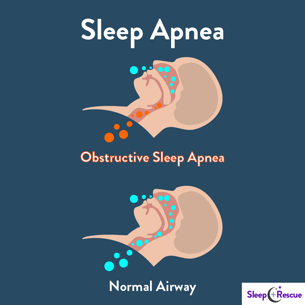 How To Recognize And Treat Sleep Apnea